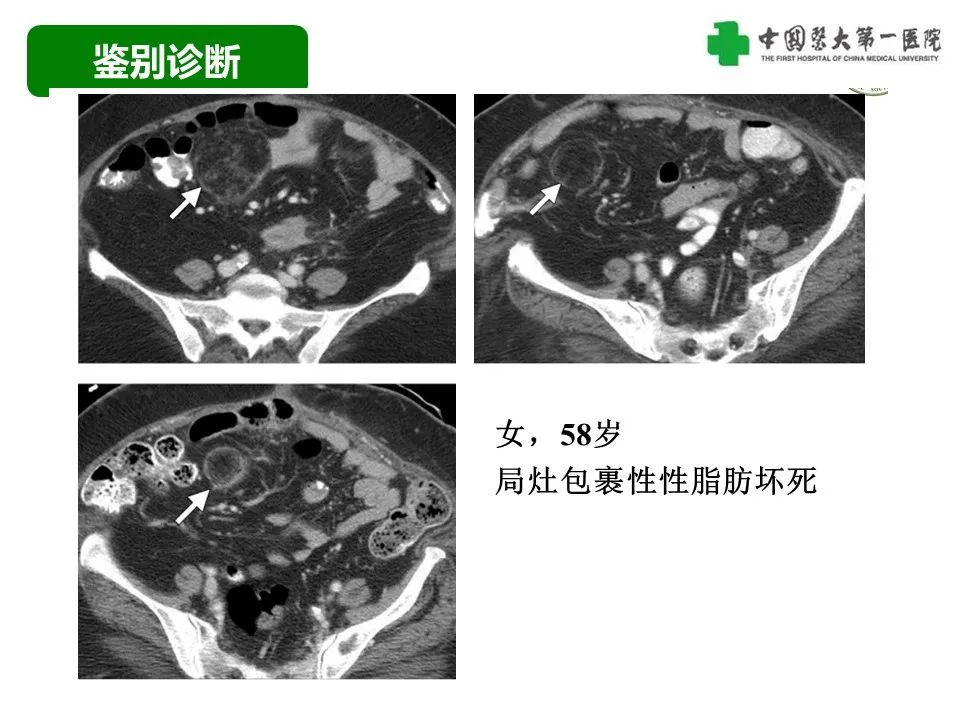 影像PPT - 【病例】腹膜后脂肪肉瘤1例CT影像-51