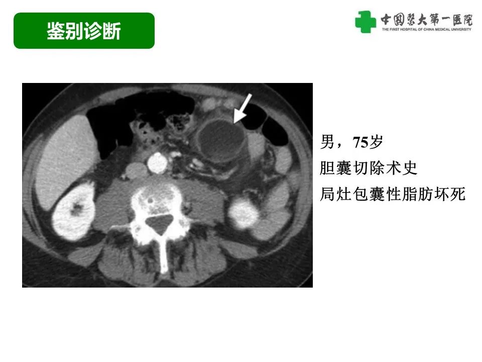 影像PPT - 【病例】腹膜后脂肪肉瘤1例CT影像-50