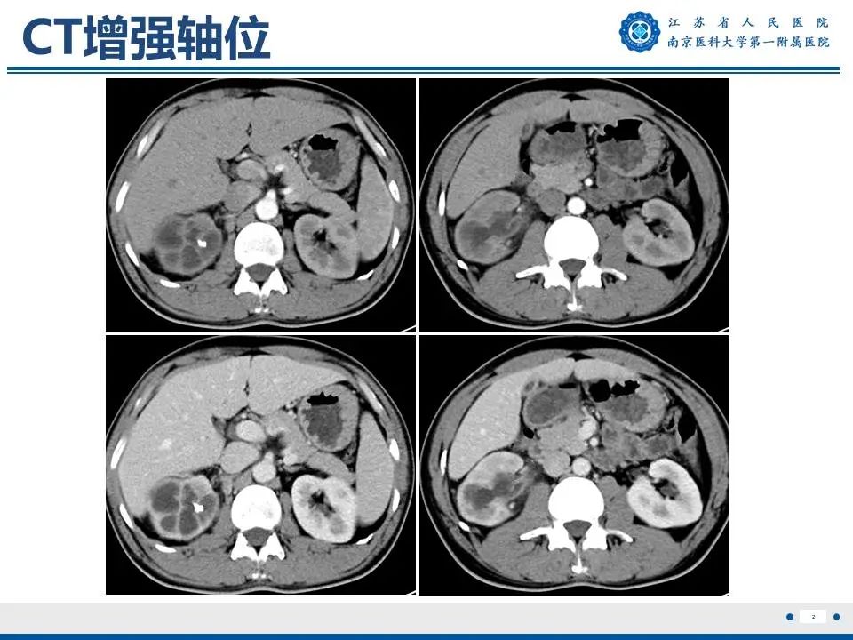 影像PPT - 【PPT】肾结核-3
