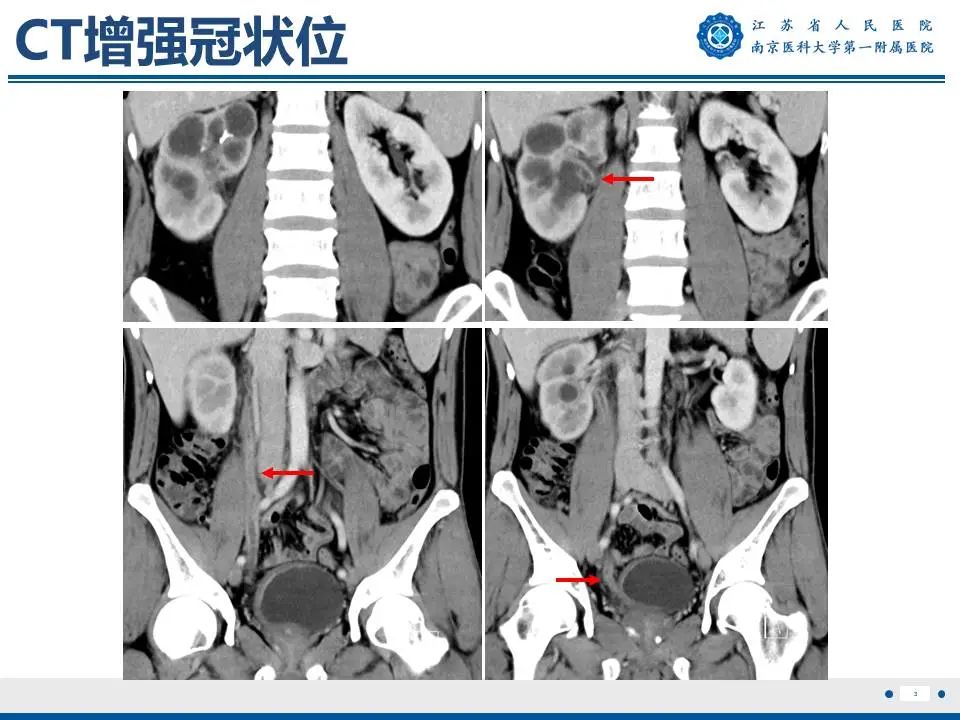 影像PPT - 【PPT】肾结核-4