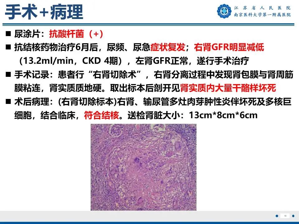 影像PPT - 【PPT】肾结核-14