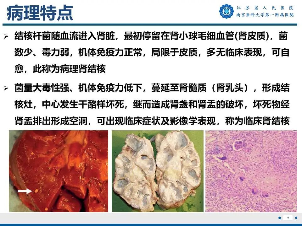 影像PPT - 【PPT】肾结核-17