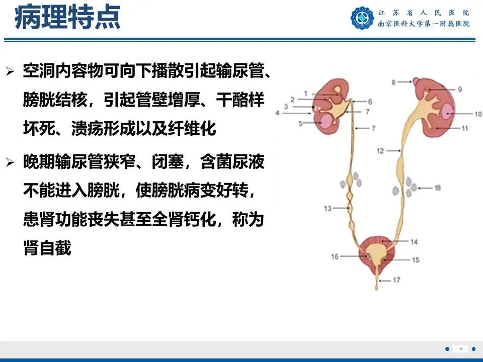 影像PPT - 【PPT】肾结核-18
