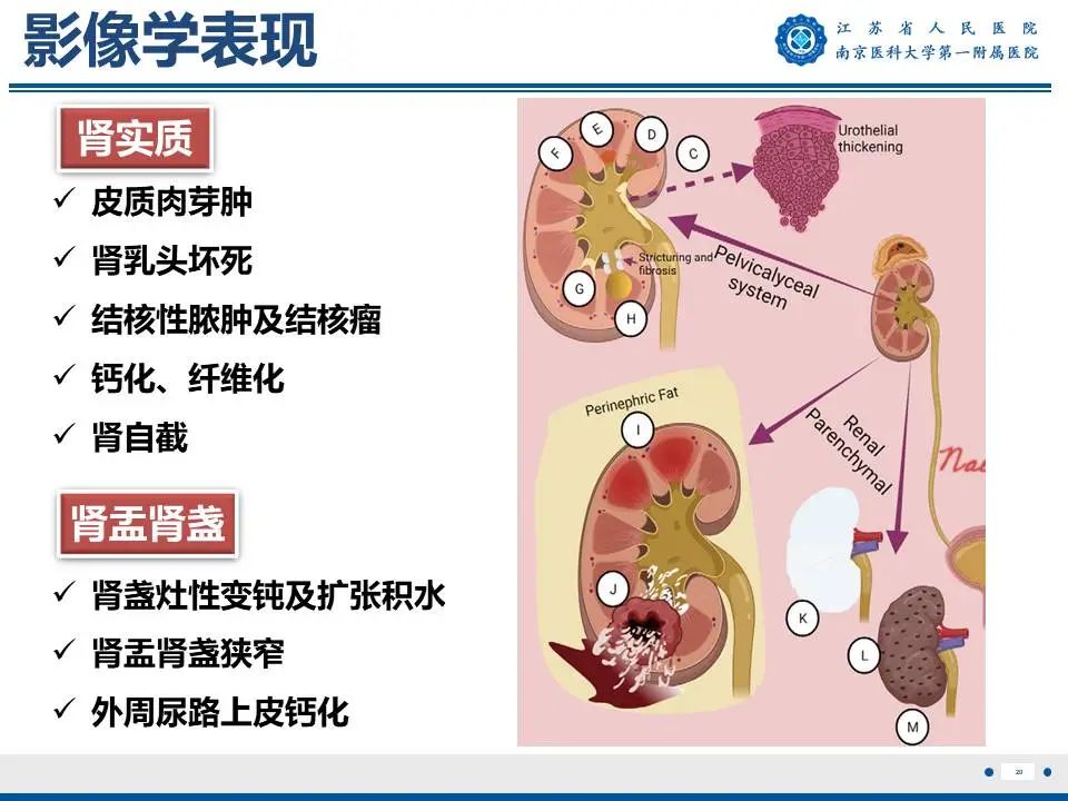 影像PPT - 【PPT】肾结核-21