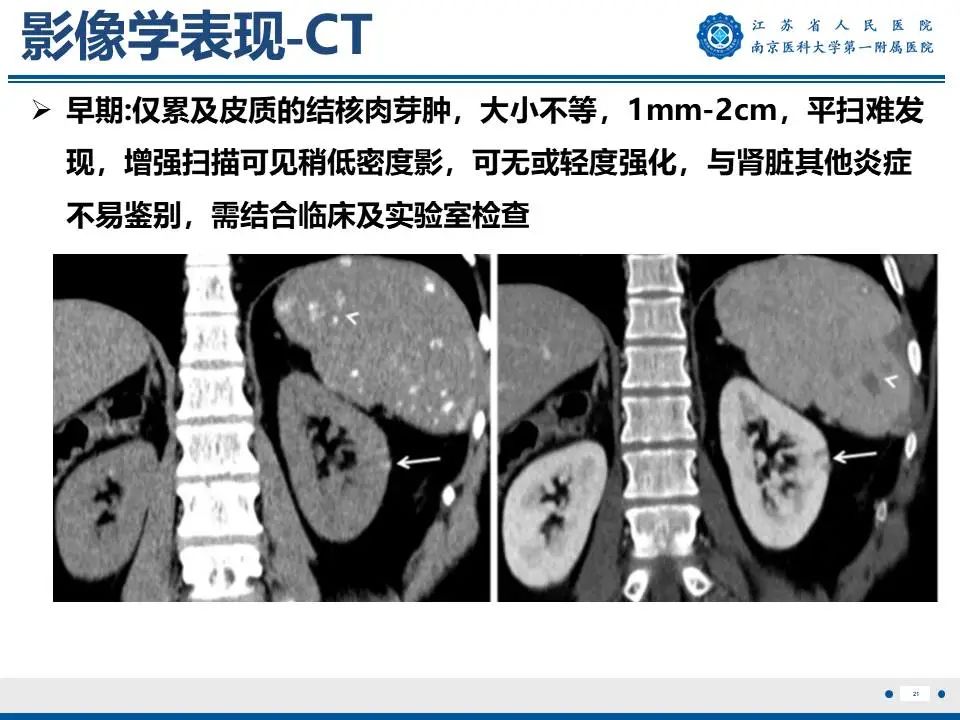 影像PPT - 【PPT】肾结核-22