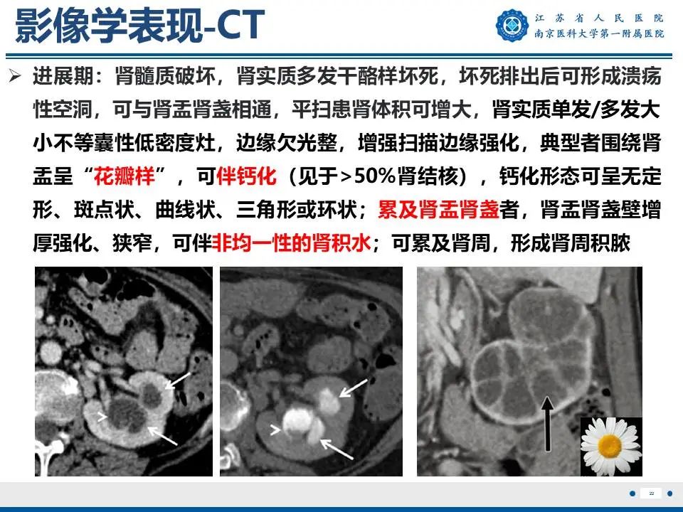 影像PPT - 【PPT】肾结核-23