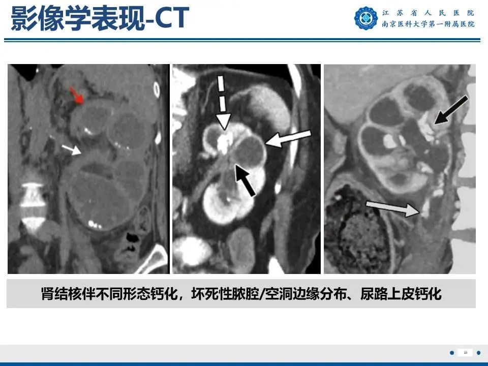 影像PPT - 【PPT】肾结核-24