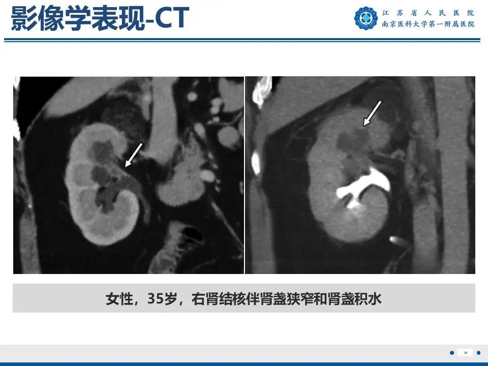影像PPT - 【PPT】肾结核-25