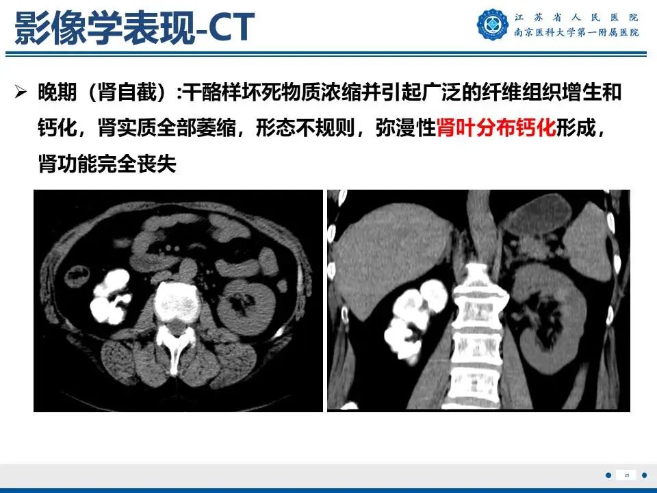 影像PPT - 【PPT】肾结核-26