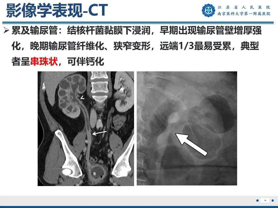 影像PPT - 【PPT】肾结核-27