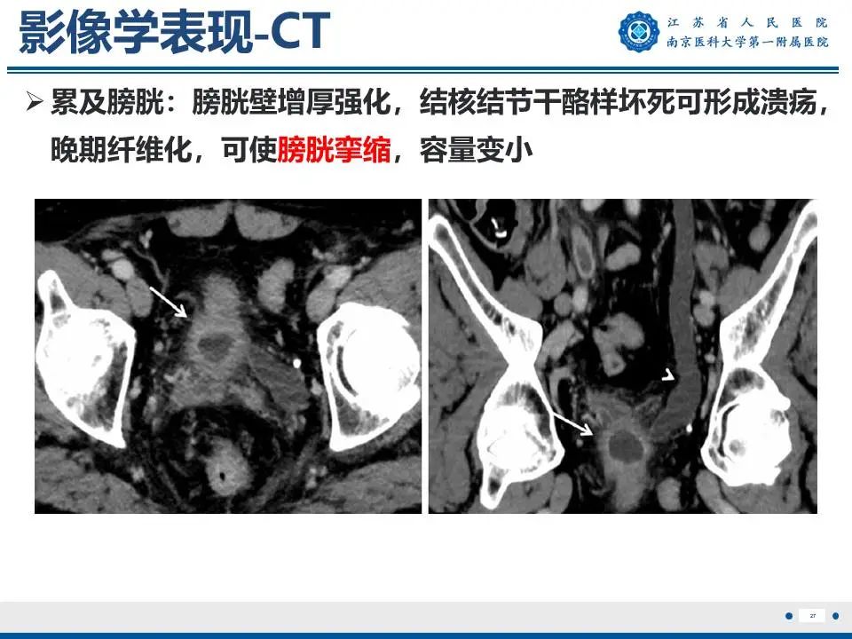 影像PPT - 【PPT】肾结核-28