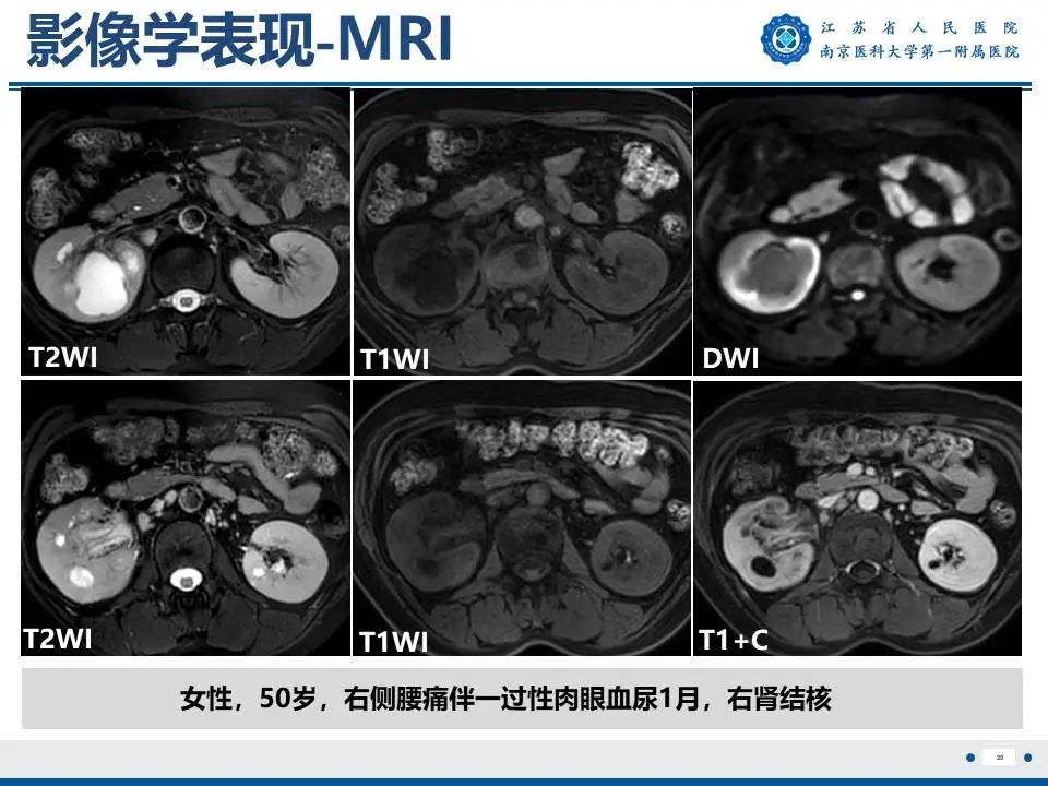 影像PPT - 【PPT】肾结核-30