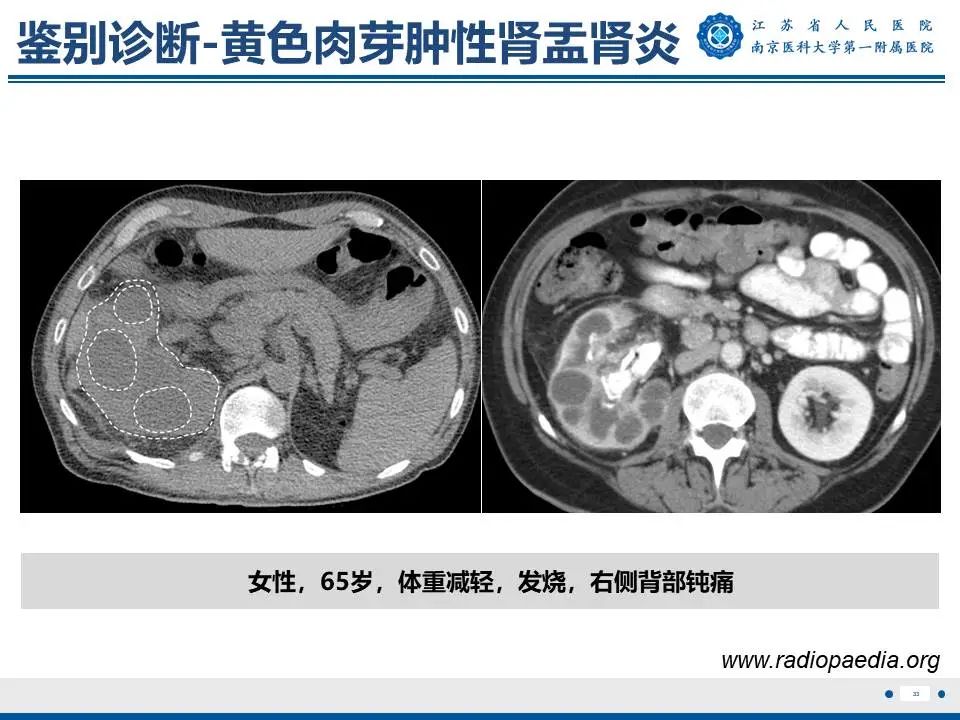 影像PPT - 【PPT】肾结核-34