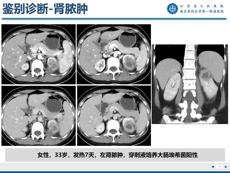 影像PPT - 【PPT】肾结核-36