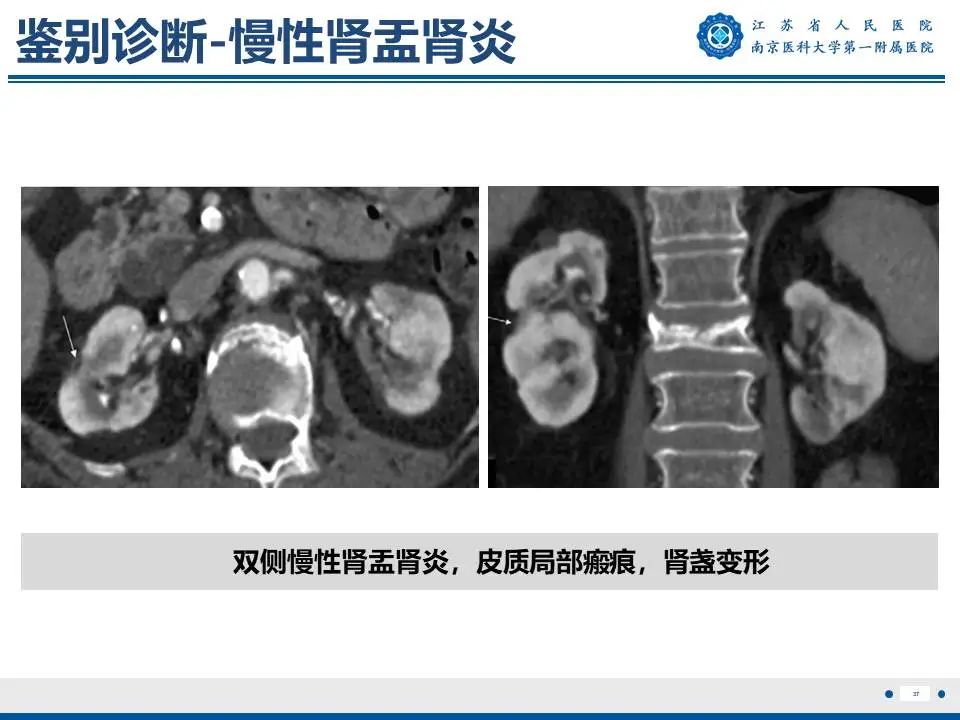 影像PPT - 【PPT】肾结核-38
