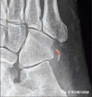 影像PPT - 籽骨、副骨、永存骨化中心、撕脱性骨折-10 影像PPT - 籽骨、副骨、永存骨化中心、撕脱性骨折-10