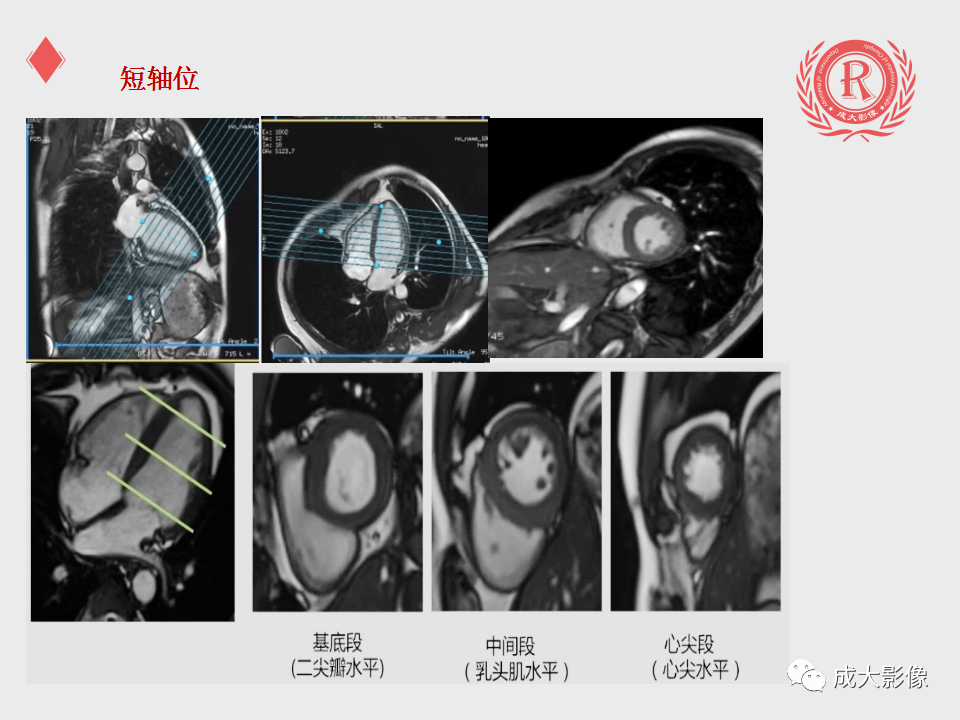 影像PPT - 【PPT】心脏MRI检查规范-9