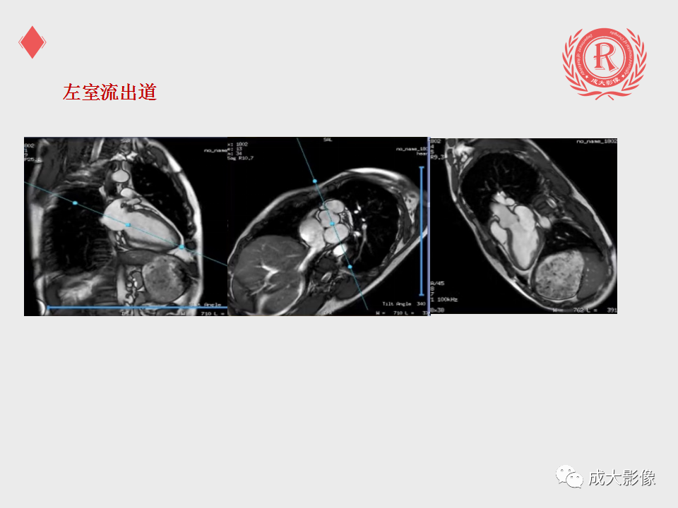 影像PPT - 【PPT】心脏MRI检查规范-10