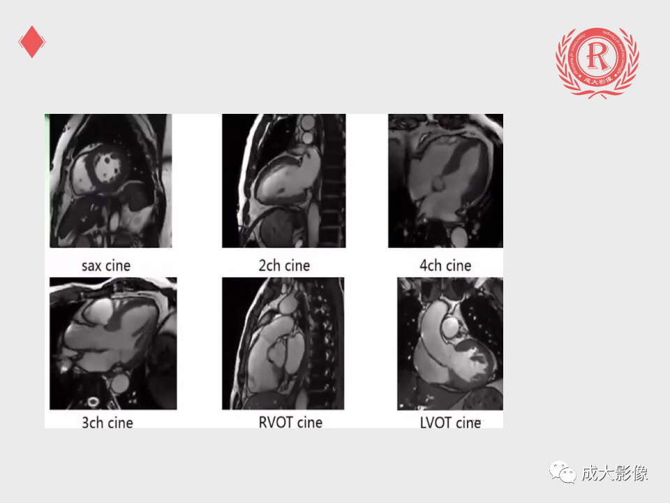 影像PPT - 【PPT】心脏MRI检查规范-11