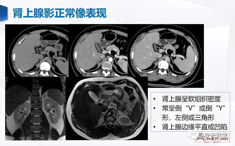 影像PPT - 【PPT】肾上腺增粗影像表现及意义-6