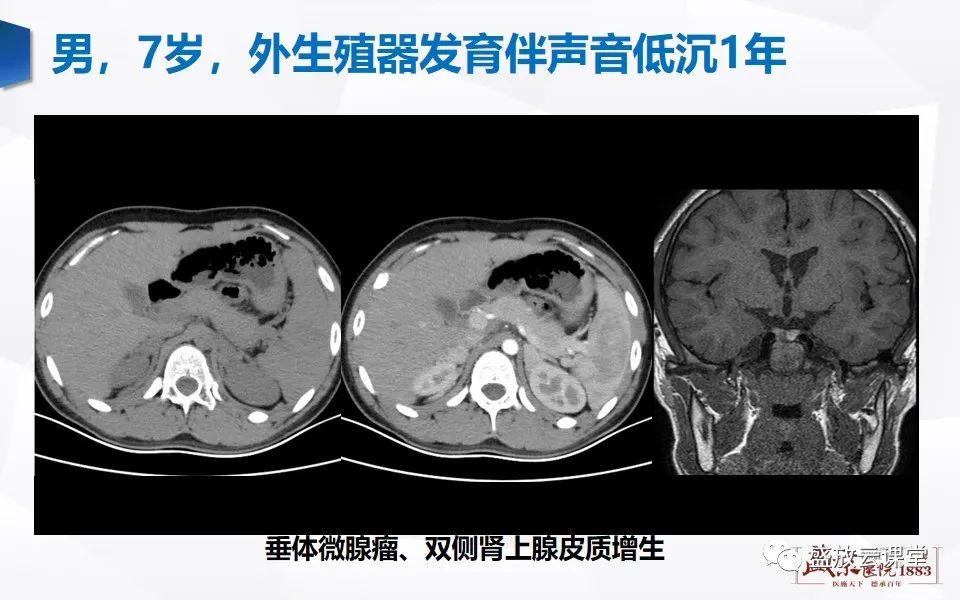 影像PPT - 【PPT】肾上腺增粗影像表现及意义-12