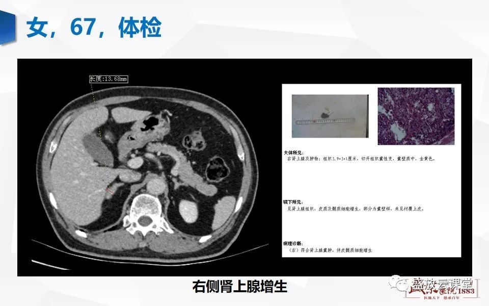影像PPT - 【PPT】肾上腺增粗影像表现及意义-13