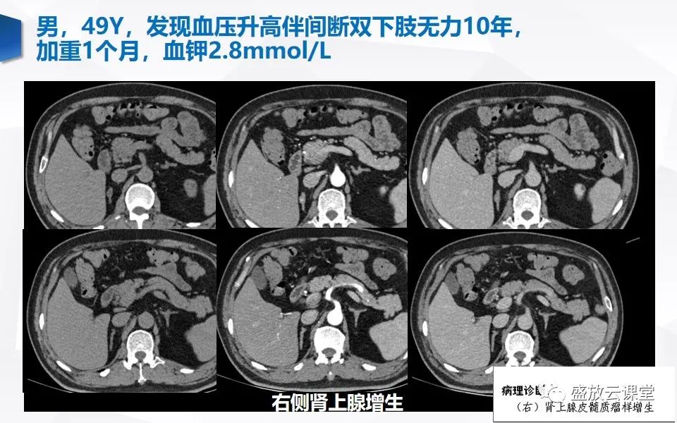 影像PPT - 【PPT】肾上腺增粗影像表现及意义-14