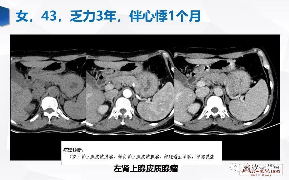 影像PPT - 【PPT】肾上腺增粗影像表现及意义-15