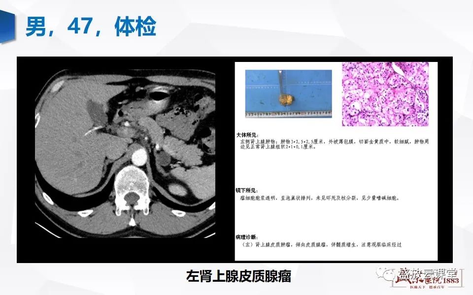 影像PPT - 【PPT】肾上腺增粗影像表现及意义-16
