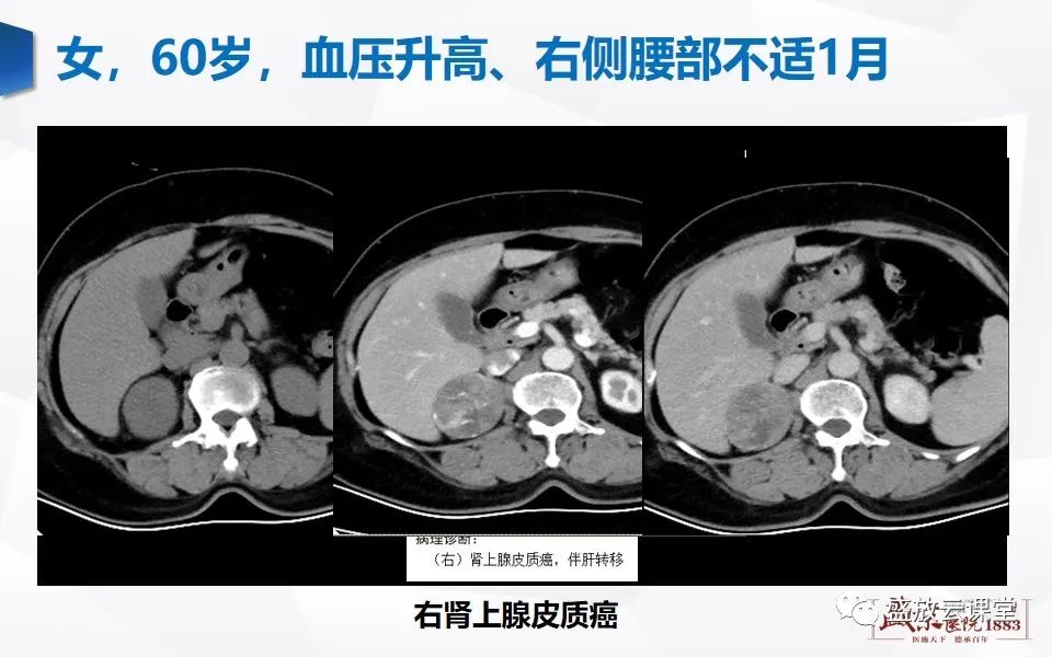 影像PPT - 【PPT】肾上腺增粗影像表现及意义-17