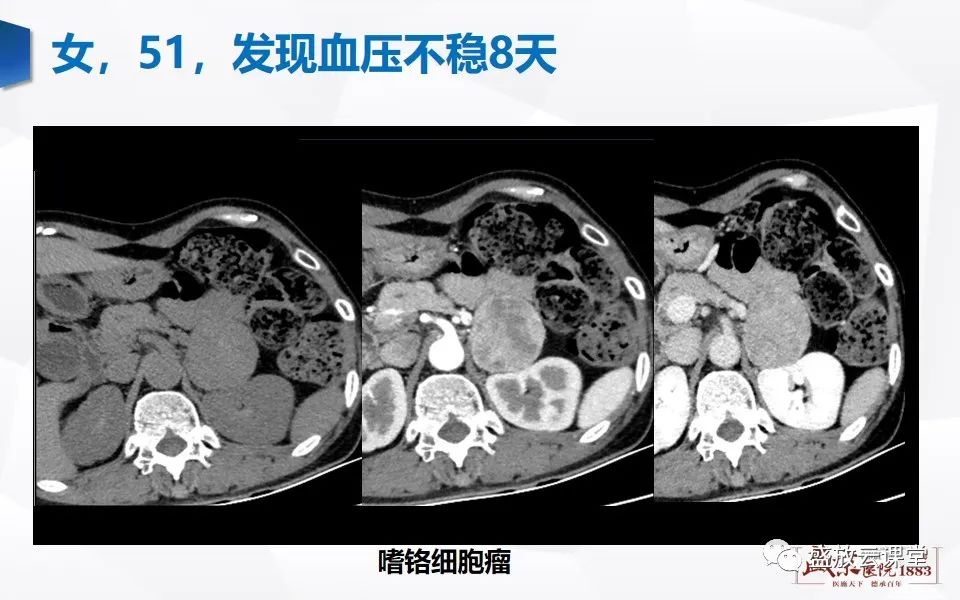 影像PPT - 【PPT】肾上腺增粗影像表现及意义-18