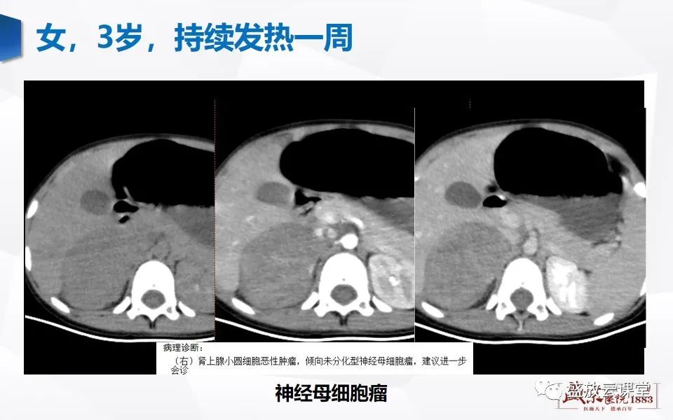 影像PPT - 【PPT】肾上腺增粗影像表现及意义-19