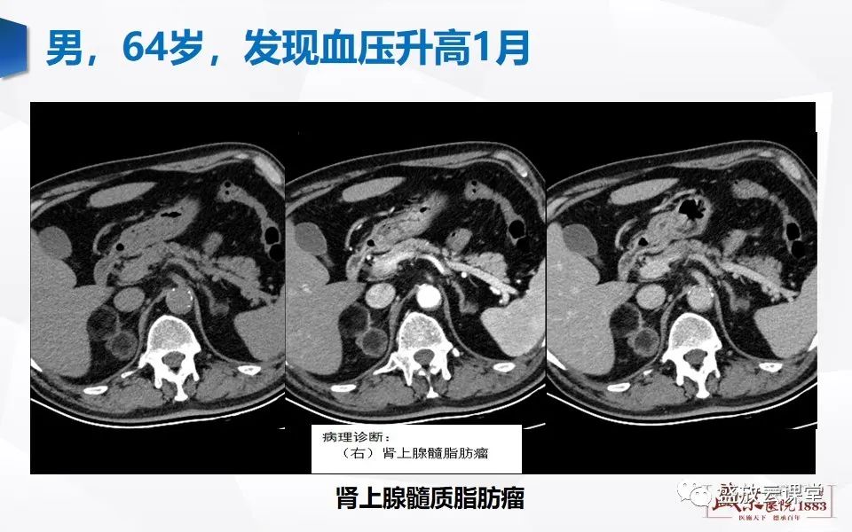 影像PPT - 【PPT】肾上腺增粗影像表现及意义-20