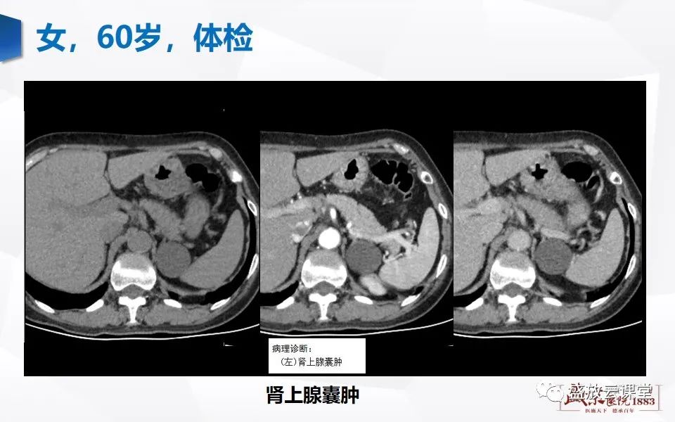 影像PPT - 【PPT】肾上腺增粗影像表现及意义-21