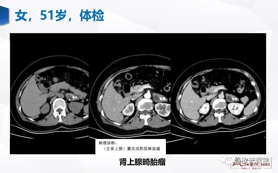影像PPT - 【PPT】肾上腺增粗影像表现及意义-22