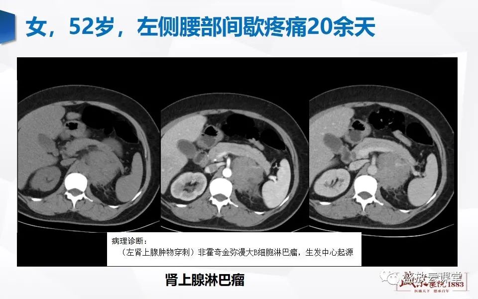 影像PPT - 【PPT】肾上腺增粗影像表现及意义-24
