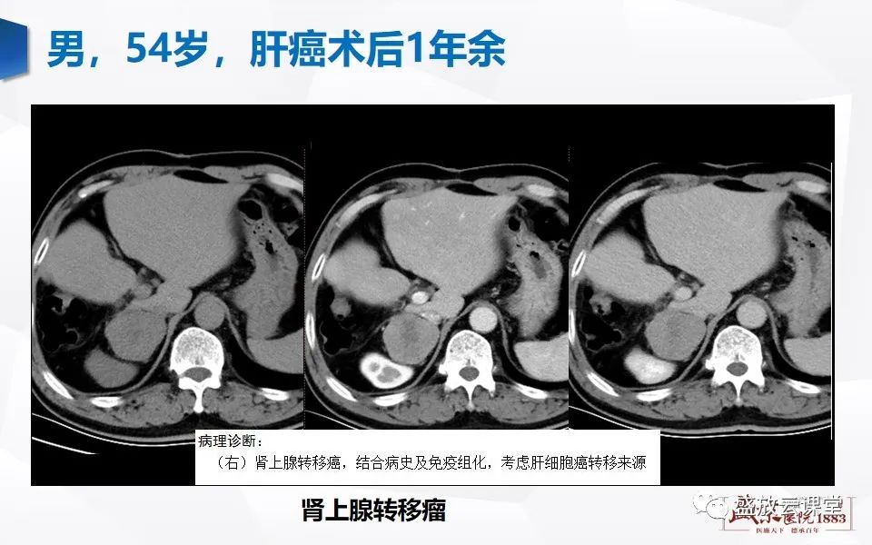 影像PPT - 【PPT】肾上腺增粗影像表现及意义-23