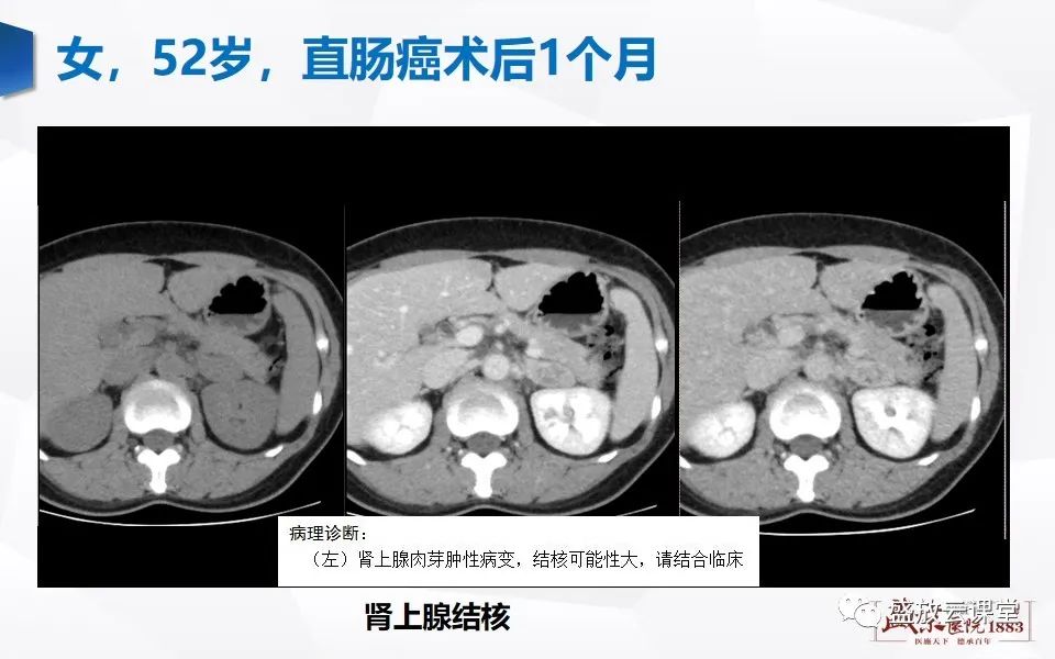 影像PPT - 【PPT】肾上腺增粗影像表现及意义-25
