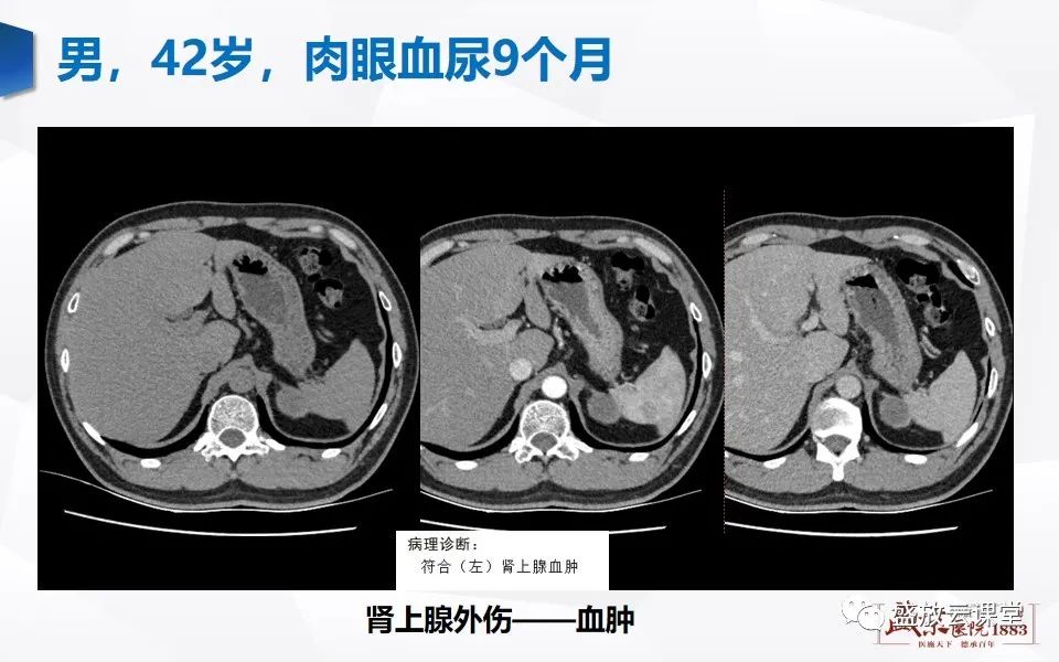 影像PPT - 【PPT】肾上腺增粗影像表现及意义-26