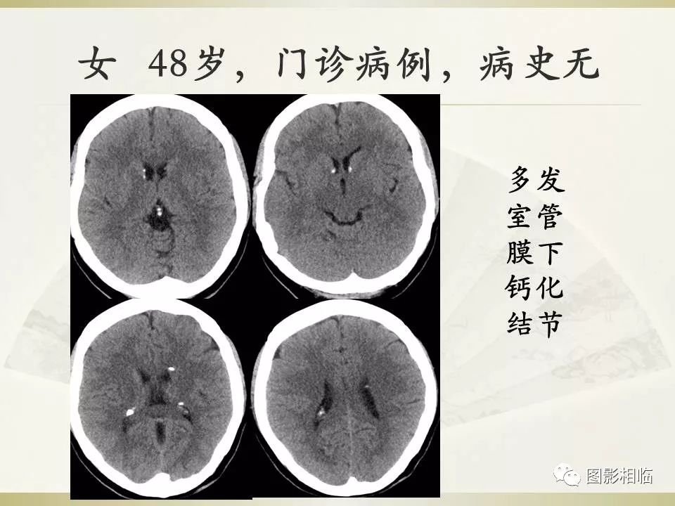 影像PPT - 【PPT】TSC临床及影像表现-2