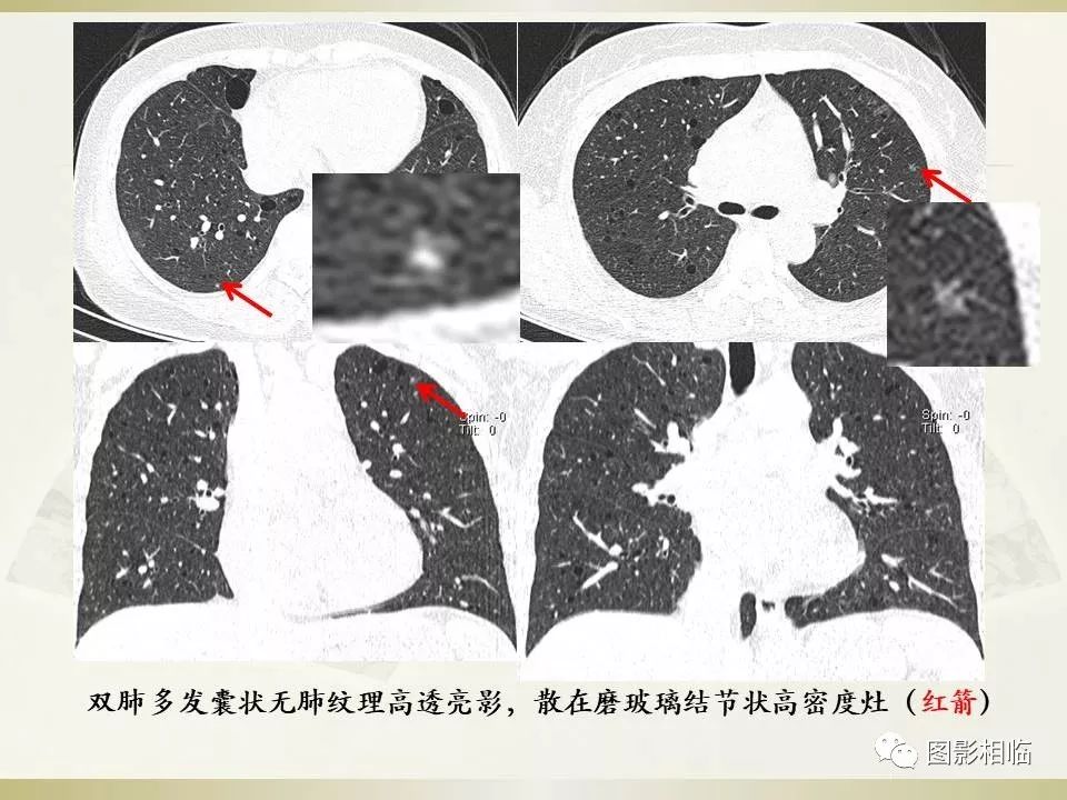 影像PPT - 【PPT】TSC临床及影像表现-3