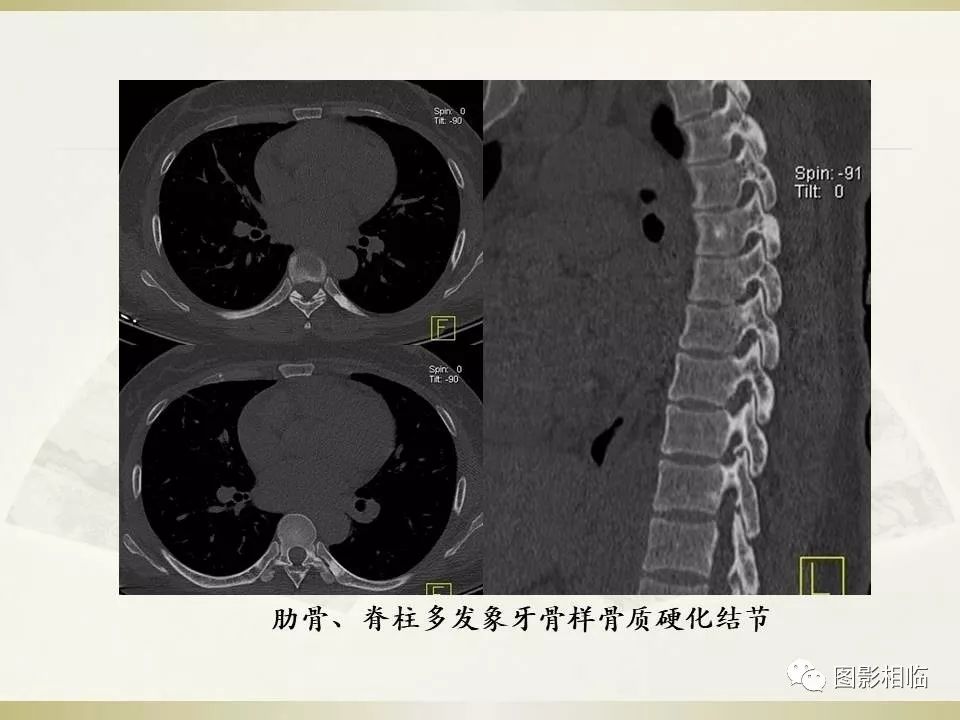 影像PPT - 【PPT】TSC临床及影像表现-4