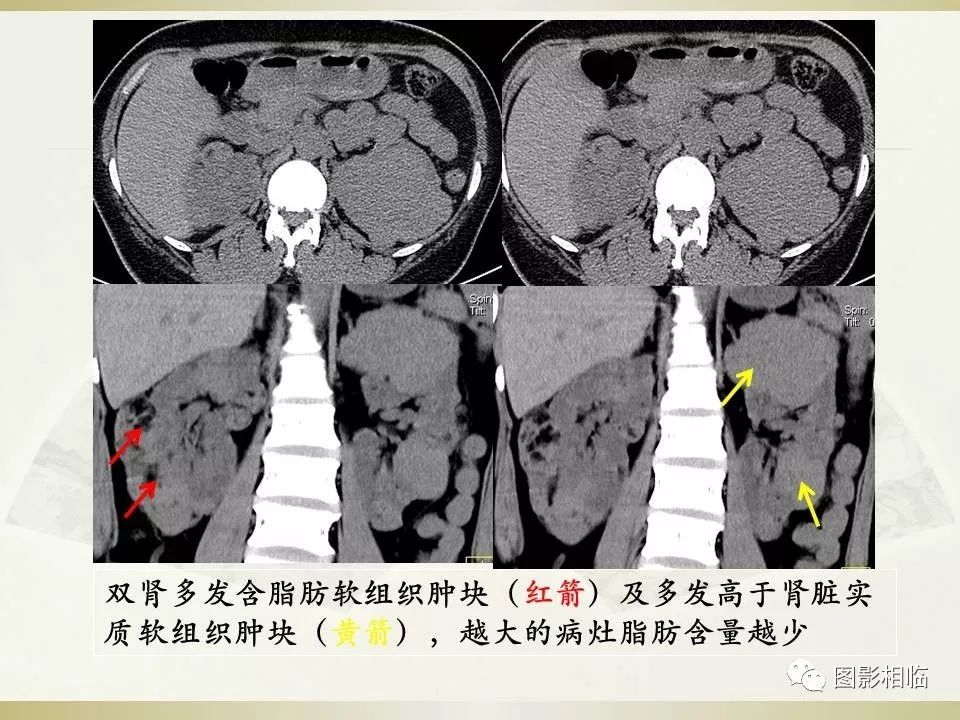 影像PPT - 【PPT】TSC临床及影像表现-5