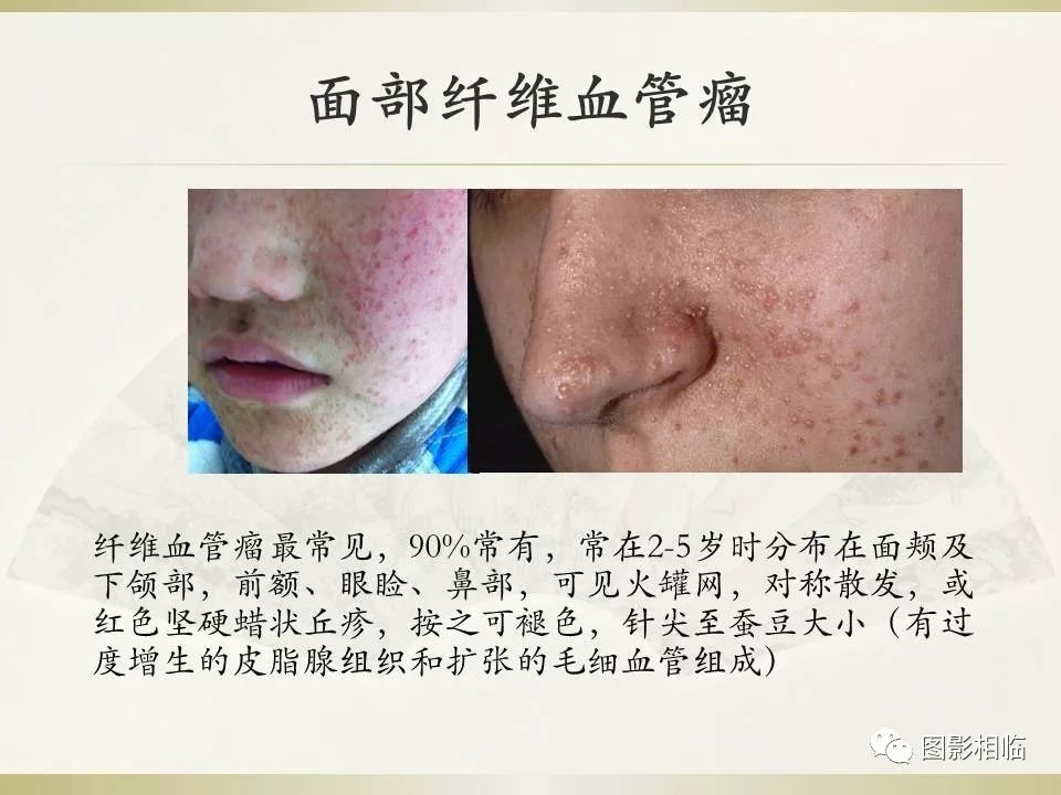 影像PPT - 【PPT】TSC临床及影像表现-13