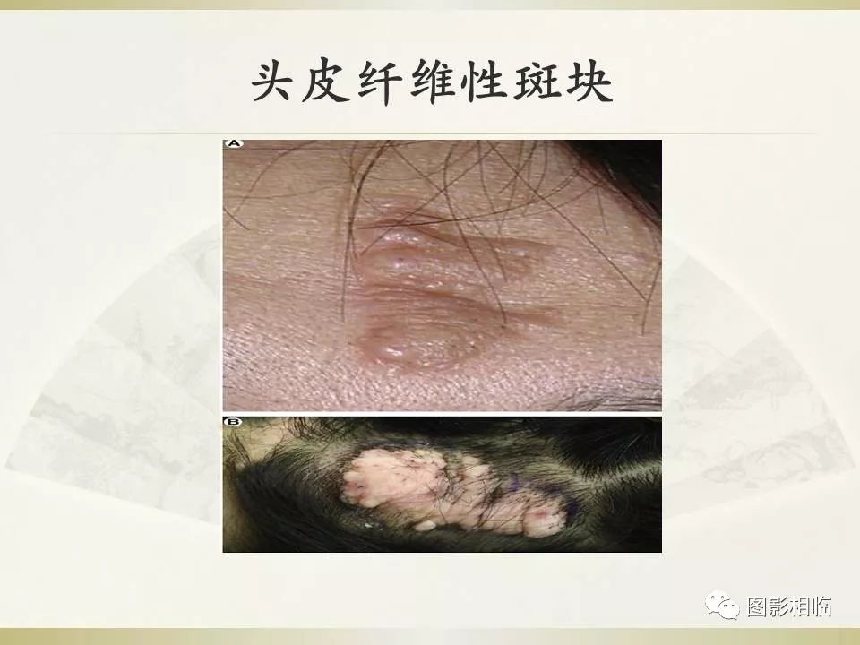 影像PPT - 【PPT】TSC临床及影像表现-14