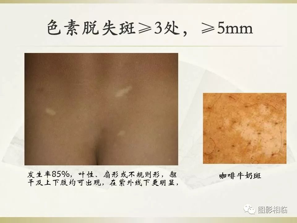 影像PPT - 【PPT】TSC临床及影像表现-15