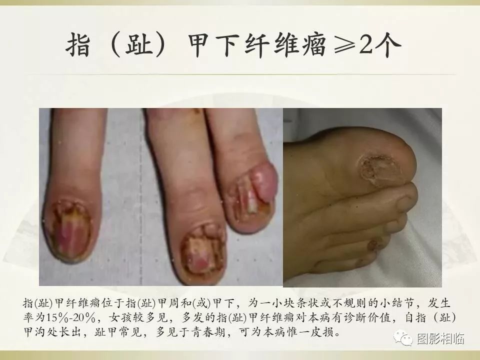 影像PPT - 【PPT】TSC临床及影像表现-16