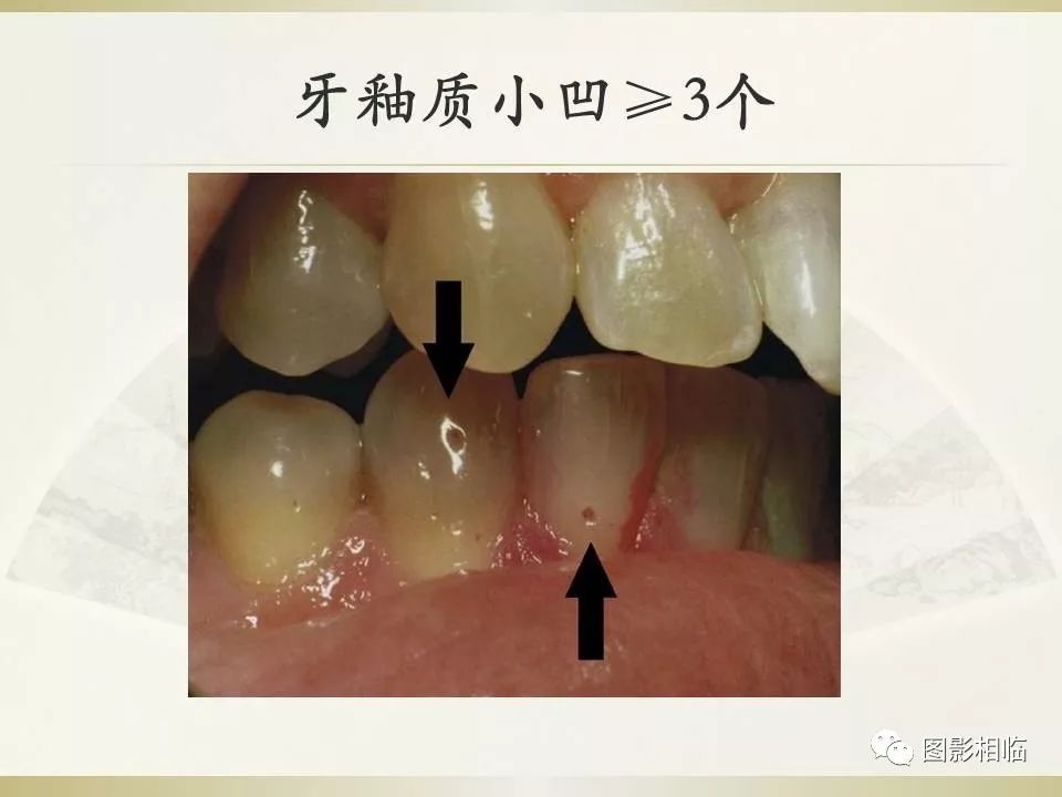 影像PPT - 【PPT】TSC临床及影像表现-19