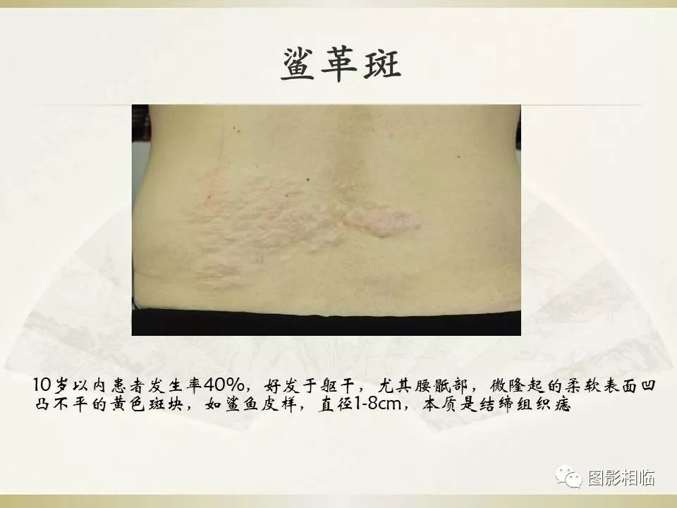 影像PPT - 【PPT】TSC临床及影像表现-17