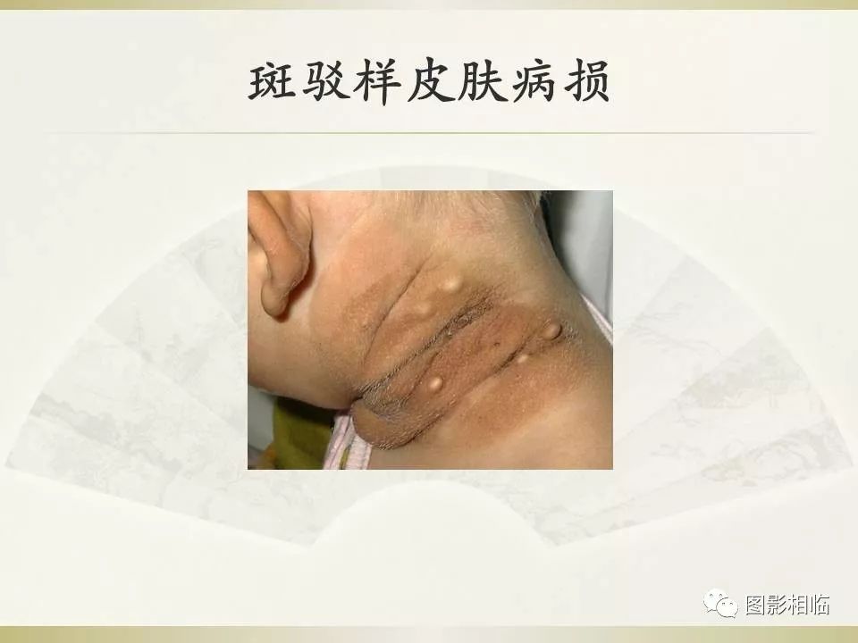 影像PPT - 【PPT】TSC临床及影像表现-18